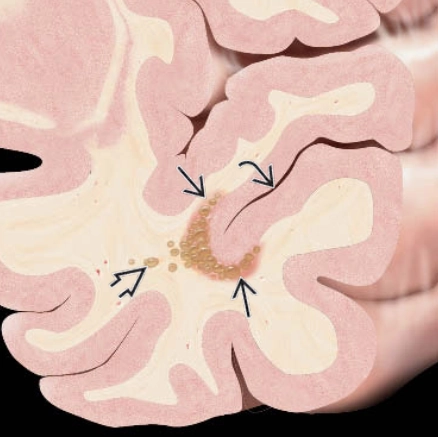 U thần kinh đa nốt và tạo không bào (Multinodular and vacuolating neuronal tumors - MVNT) 