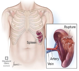 Chấn thương lách (Splenic trauma)