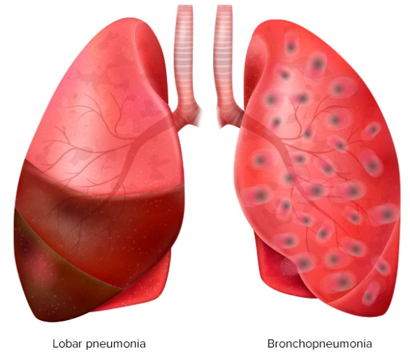 Viêm phế quản phế viêm (Bronchopneumonia)/ Viêm phổi thùy (Lobular pneumonia)