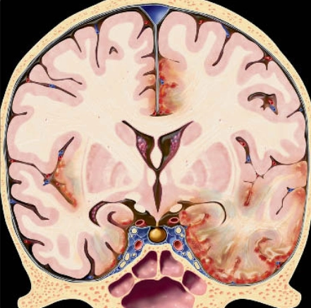 Viêm não do Herpes simplex (HSV) ở trẻ em và người lớn (Herpes simplex encephalitis)