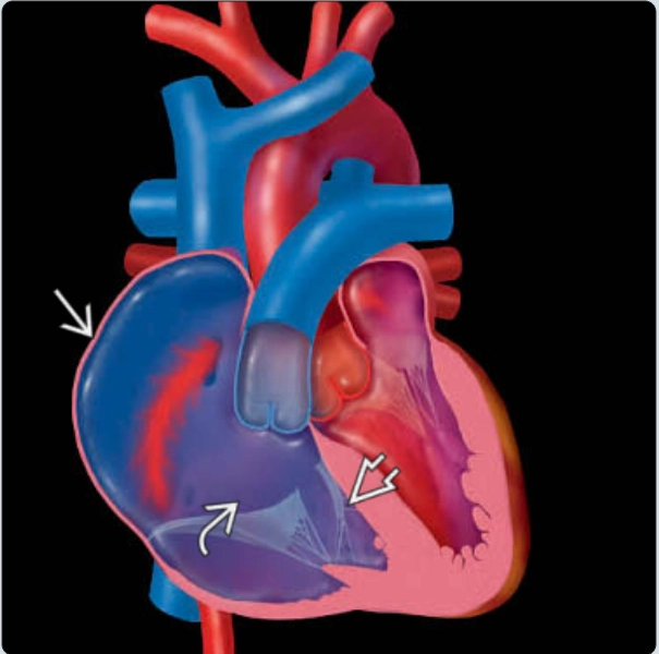 Bất thường Ebstein