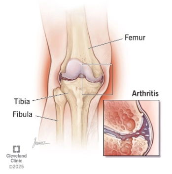  Thoái hóa khớp gối (Osteoarthritis of the knee)