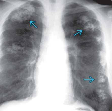 Vôi hóa phổi di căn (Metastatic pulmonary calcification - MPC)