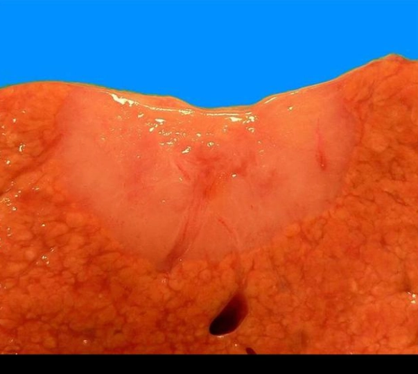 Đa u mô thừa đường mật/Hamartoma đường mật đa ổ (Multiple Biliary Hamartomas - MBH)