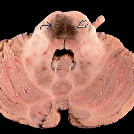 Giãn mao mạch ở hệ thần kinh trung ương (CNS capillary telangiectasias)