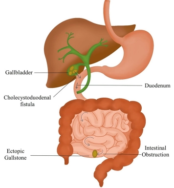 Tắc ruột do sỏi mật (Gallstone Ileus)