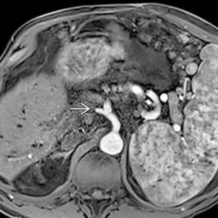 Tổn thương đường mật dạng thiếu máu cục bộ (Ischemic-Type Biliary Lesions - ITBL)