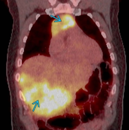 Ung thư biểu mô tuyến ức (Thymic carcinoma)