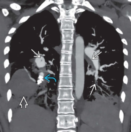 Bệnh Behçet (Biểu hiện ở lồng ngực)