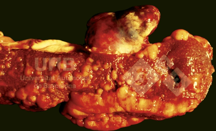 Lymphoma lách (Splenic lymphoma)