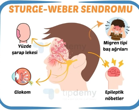 Hội chứng Sturge-Weber (Sturge-Weber syndrome)