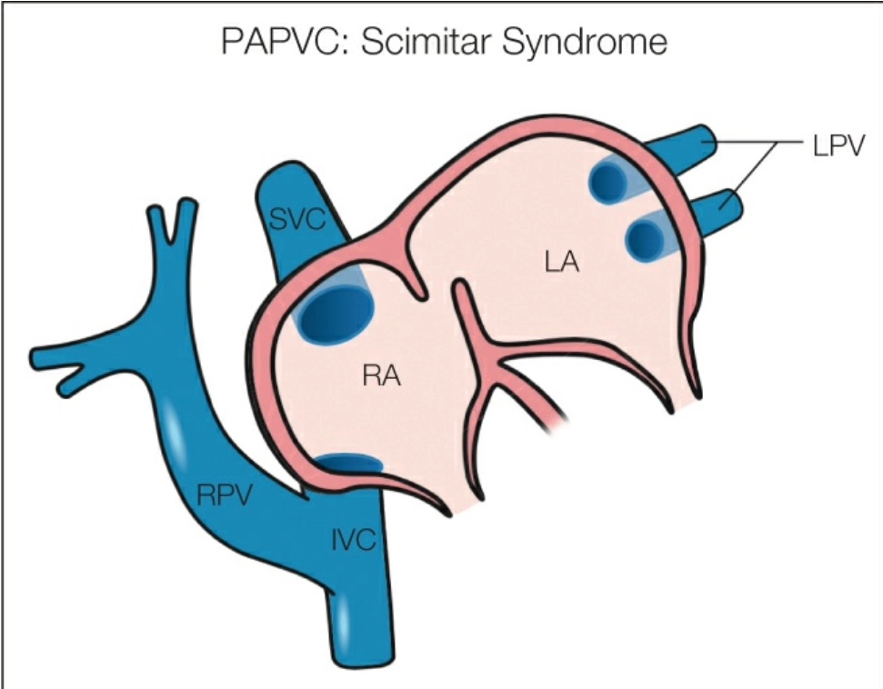 Bất thường hồi lưu tĩnh mạch phổi bán phần (PAPVC)