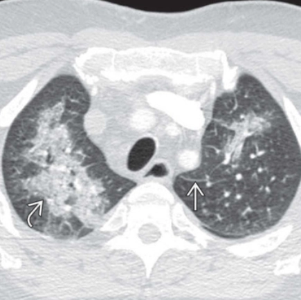 Đông đặc nhu mô phổi (Consolidation)