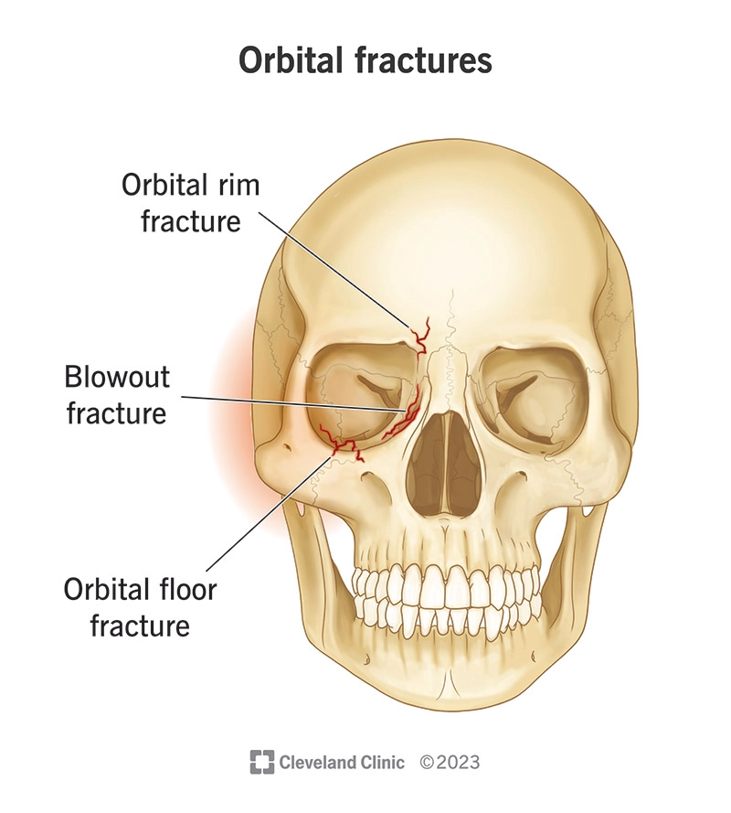 Gãy hốc mắt "blow-out" (Orbital blow-out fracture)
