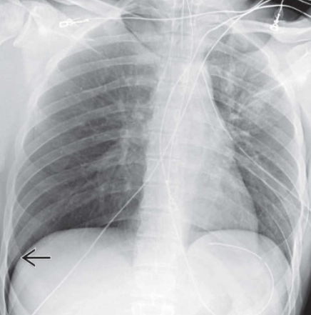 Tràn khí màng phổi do chấn thương (Traumatic pneumothorax)