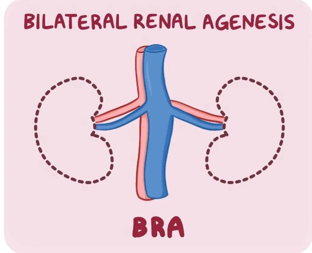 Bất sản thận hai bên thai quý I (Bilateral renal agenesis)