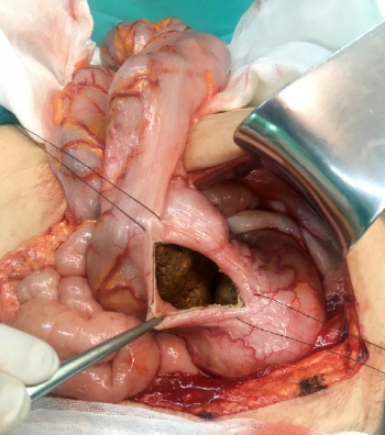 Tắc phân (Fecal impaction)