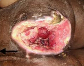 U sacrom (sarcoma) do xạ trị -  Radiation-induced sarcoma (RIS)
