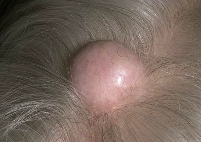 Nang bã nhờn (Sebaceous cyst - SC)/ Nang chân tóc (Trichilemmal cyst - TC)