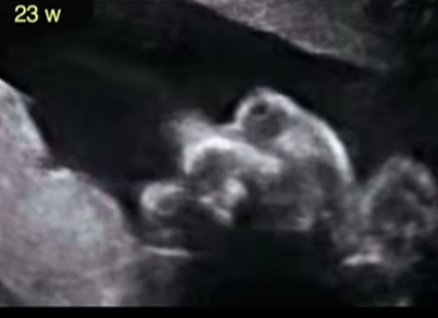 Tật hai mắt xa nhau thai nhi (Hypertelorism)