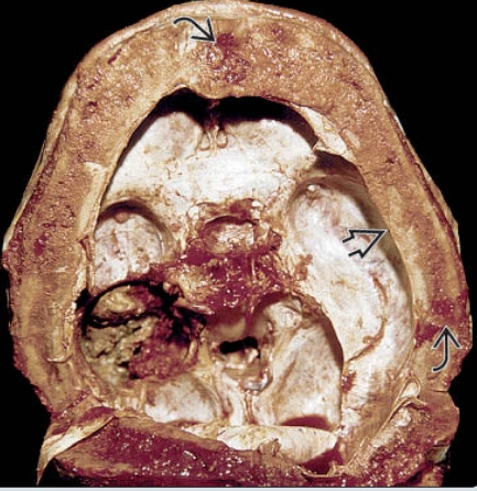 Bệnh Paget xương sọ - Paget disease (skull)
