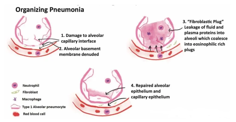 Viêm phổi tổ chức hóa (Organizing Pneumonia - OP)