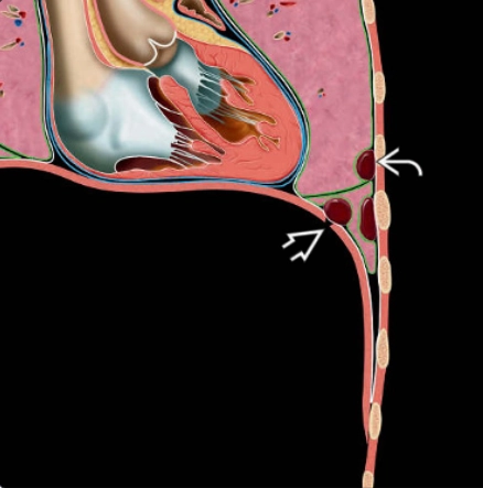 Lách lạc chỗ khoang màng phổi (Thoracic splenosis)