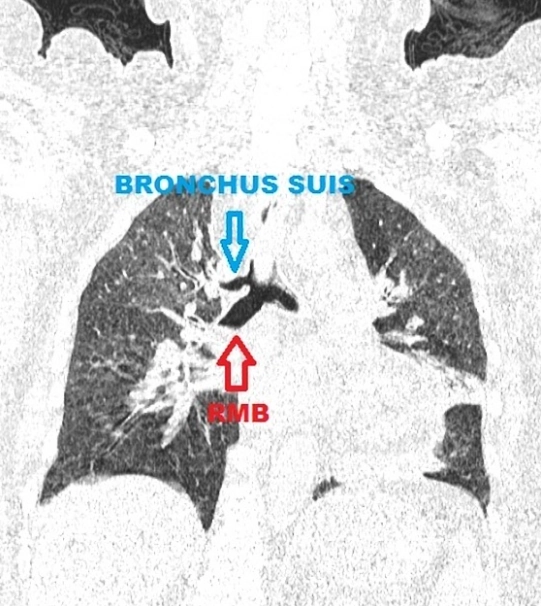Biến thể phế quản khí quản (Tracheal bronchus)