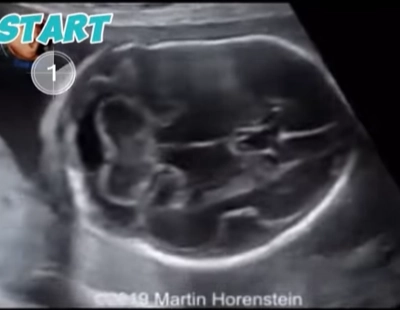 Tạo xương bất toàn tuýp II (gây chết) (Osteogenesis Imperfecta Type II - OI II)