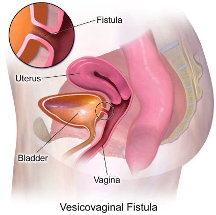 Rò bàng quang-âm đạo (Vesicovaginal fistula)