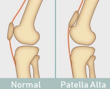 Xương bánh chè nằm cao (Patella alta)
