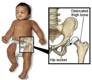 Loạn sản khớp háng (Developmental dysplasia of the hip)