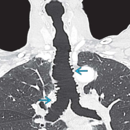 Hội chứng Mounier-Kuhn (Mounier-Kuhn syndrome - MKS)/ Bệnh phình khí-phế quản (Tracheobronchomegaly)