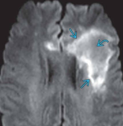 Bệnh não chất trắng đa ổ tiến triển (Progressive Multifocal Leukoencephalopathy - PML)