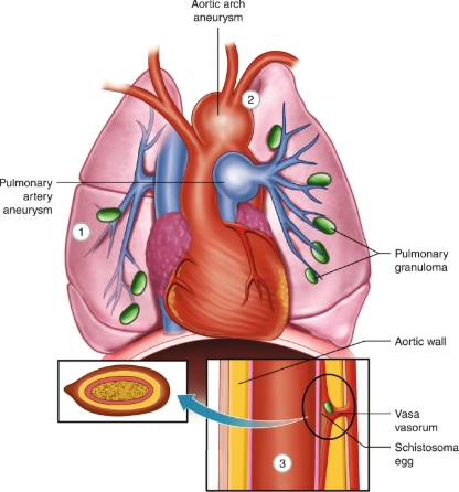 Bệnh sán máng (các biểu hiện ở gan) - Schistosomiasis (hepatic manifestations)