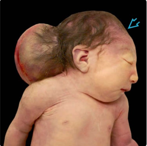 Thoát vị não- màng não vùng đỉnh- chẩm (Occipital-parietal cephalocele)