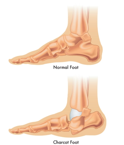 Bệnh khớp thần kinh (Neuropathic joint)/ Bệnh khớp Charcot (Charcot joint)