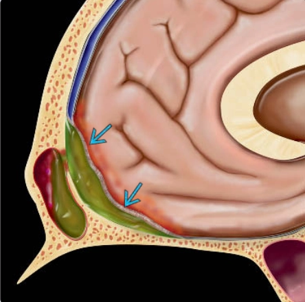 Tụ mủ dưới màng cứng (Subdural empyema)/Tụ mủ ngoài màng cứng (Epidural empyema - EDE)