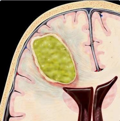 Nhiễm trùng não (Brain infection)