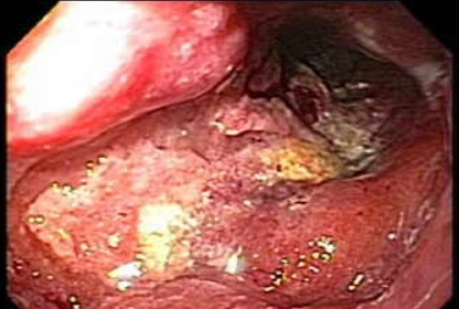 Di căn tá tràng và u lympho (Duodenal Metastases and Lymphoma)