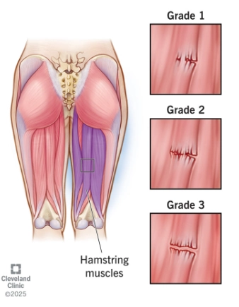 Tổn thương cơ Hamstring (gân chân ngỗng)(nhóm cơ duỗi háng)