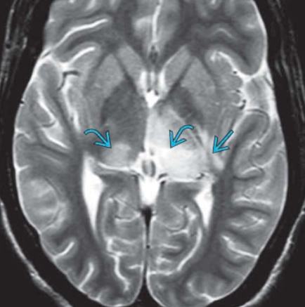 Viêm não do Virus Tây sông Nile (West Nile virus - WNV)