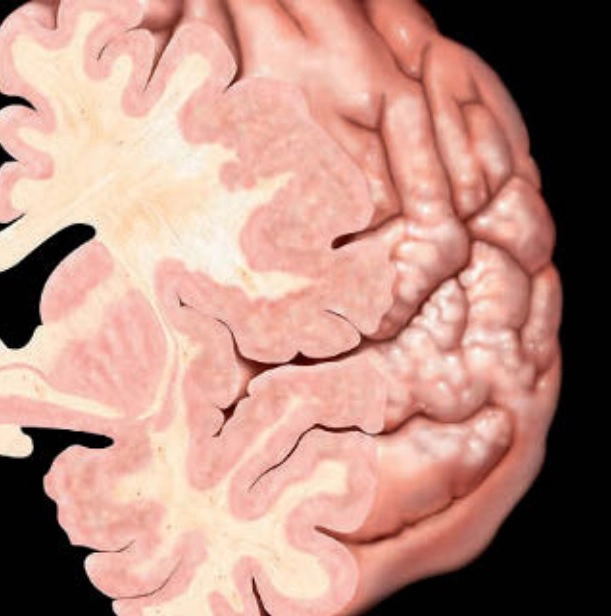 Thần kinh Nhi (Pediatric Neuroimaging)