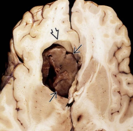 Nang lành tính quanh u (Non-neoplastic tumor associated cysts - TACs)