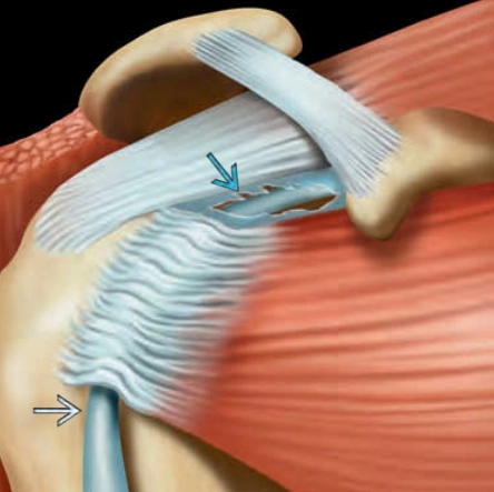 Rách khoảnh trống chóp xoay (Rotator Interval Tear)