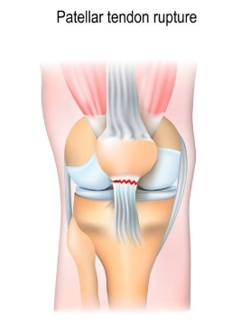 Đứt gân bánh chè (Patellar tendon rupture)