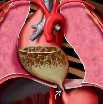 Co thắt tâm vị (Achalasia)- Hình ảnh ở ngực