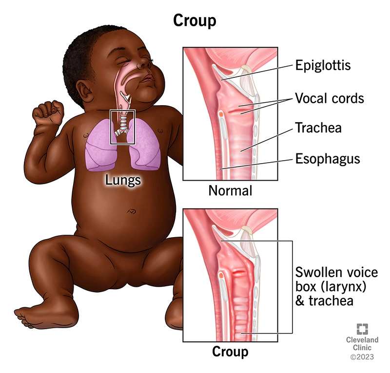 Viêm thanh khí phế quản cấp (Croup)