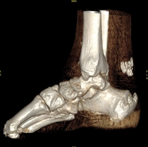Cốt hóa gân Achilles (Achilles tendon ossification)