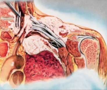 U Pancoast (Pancoast tumor)